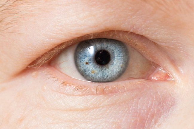 Glaucoma: come una visita può salvarti la vista